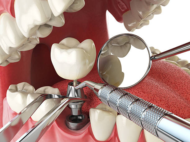 Best Dental Abscess Treatment in Central City, NE